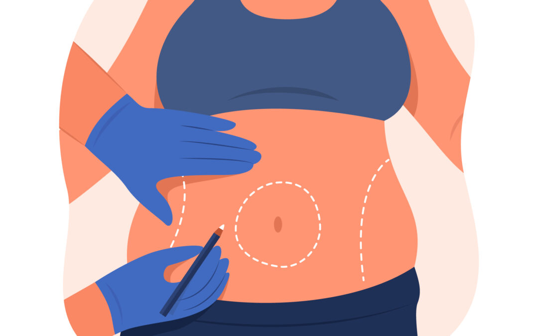 What is the difference between tummy tuck and abdominoplasty?