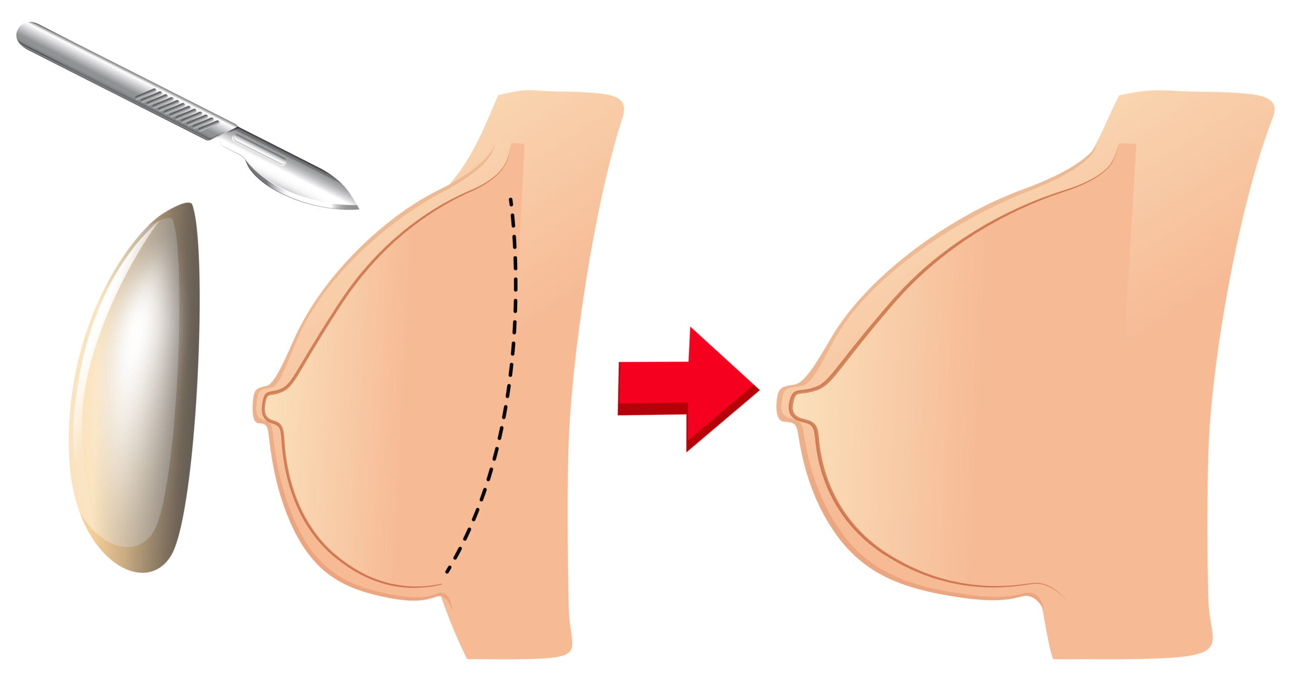 Breast reduction (mammoplasty) - Series—Indications: MedlinePlus Medical  Encyclopedia