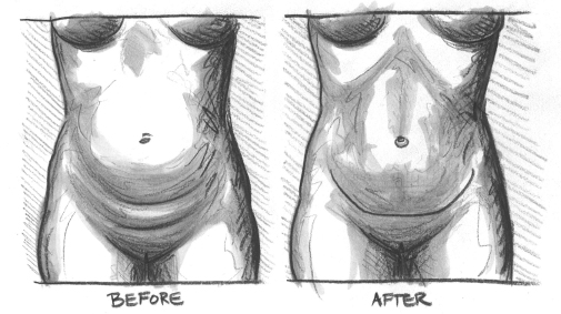 When might you have an Abdominoplasty ?