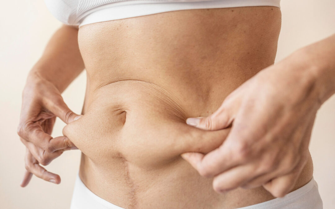Unveiling the Best: Your Guide to Tummy Tuck in Melbourne