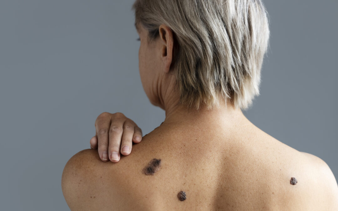 Skin Lesions Melbourne: Dr. Foti Sofiadellis