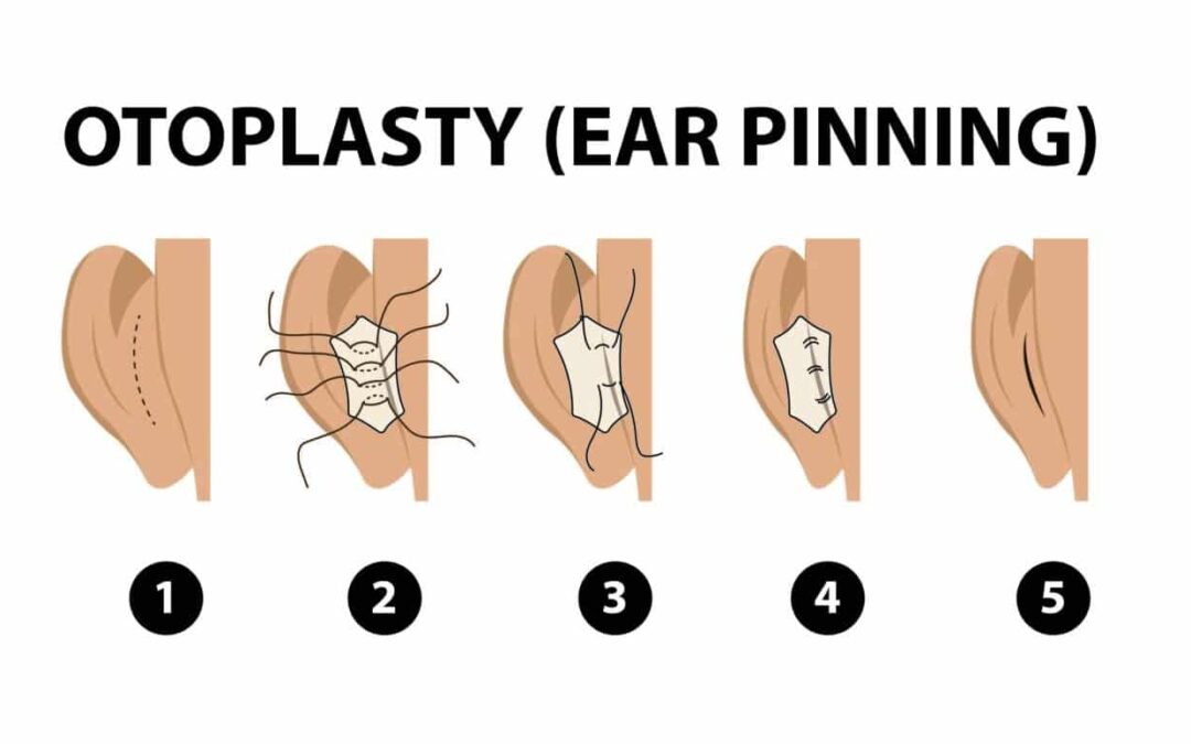 Understanding Otoplasty in Melbourne: A Guide to Ear Surgery